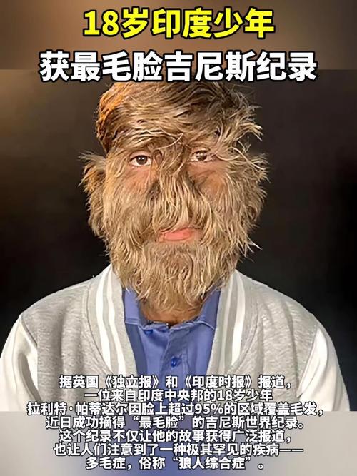 惊人！印度少年荣获吉尼斯'最毛脸'纪录，他究竟经历了什么？