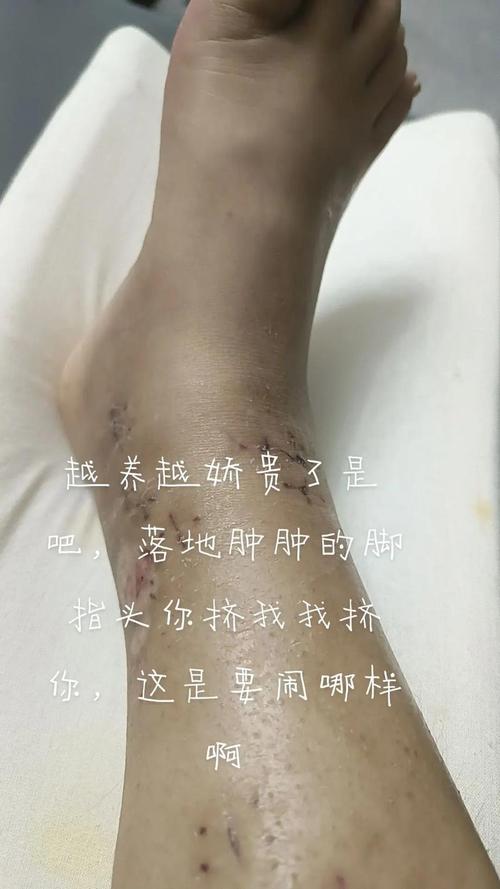 梦见骨折的5个象征意义及解梦方法解析 梦见骨折的5个象征意义及解梦方法解析