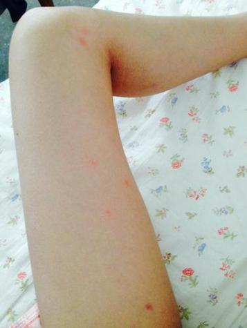 梦见叮咬的7个心理暗示及其解决方法解析