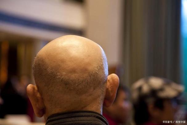 梦见光头预示哪些？专家解读隐藏的征兆与心理暗示