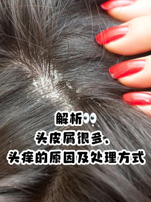 深入解析梦见头皮屑的背后含义及应对策略