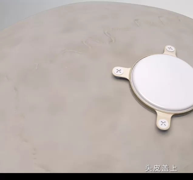 脑机接口革命：中国首例侵入式临床试验将如何改变游戏体验？探索科学新前沿！