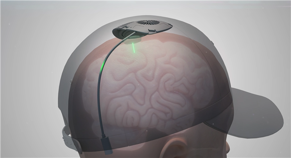 脑机接口革命：中国首例侵入式临床试验将如何改变游戏体验？探索科学新前沿！