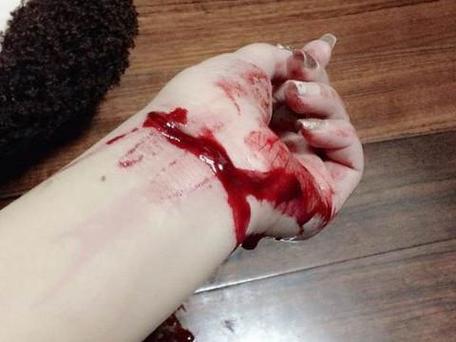 梦见手腕开刀预示哪些？解读梦境背后的心理暗示与解决方法