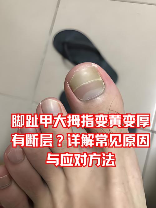 梦见脚趾甲解析揭示梦境背后的深层含义与高效解决方案 梦见脚趾甲解析揭示梦境背后的深层含义与高效解决方案
