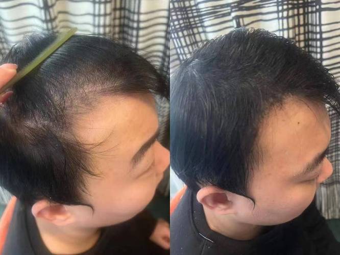 梦见秃顶的深层心理解析,专家揭示潜在焦虑与生活启示! 梦见秃顶的深层心理解析,专家揭示潜在焦虑与生活启示!