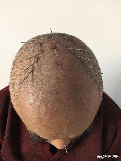 梦见大头针的5种释义巧妙解析心理暗示与生活影响 梦见大头针的5种释义巧妙解析心理暗示与生活影响