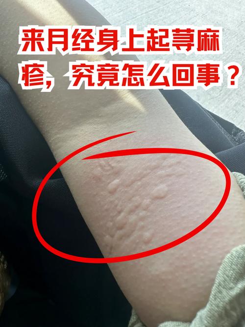 梦见荨麻的深层寓意揭示5个心理学权威观点 梦见荨麻的深层寓意揭示5个心理学权威观点