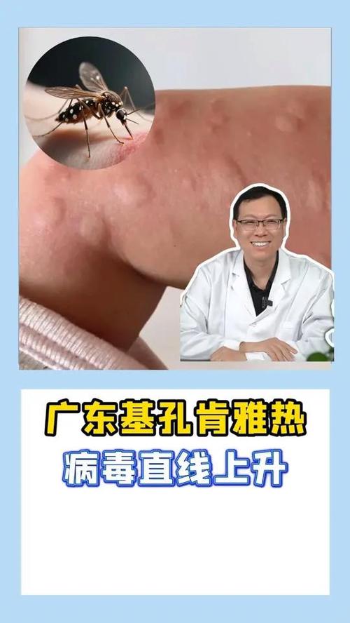 【今日顺德关注】478例基孔肯雅热确诊：了解轻症应对，确保健康安全！